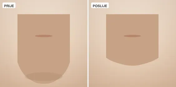 Liposukcija podbratka — slučaj 1, prije i poslije