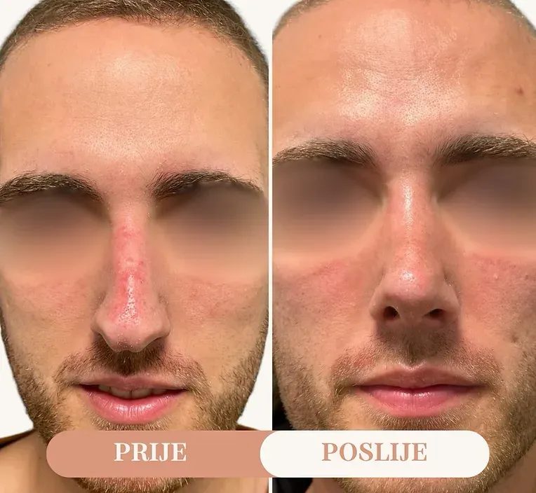 Rinoplastika — slučaj 10, prije i poslije