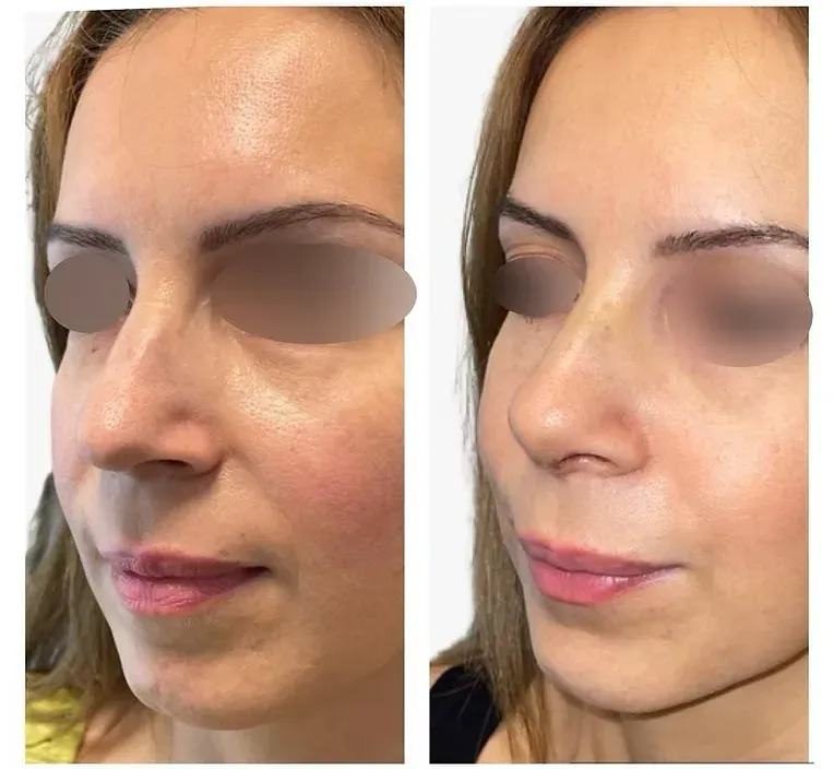 Rinoplastika — slučaj 11, prije i poslije