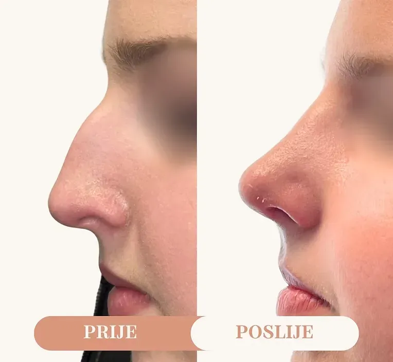 Rinoplastika — slučaj 2, prije i poslije