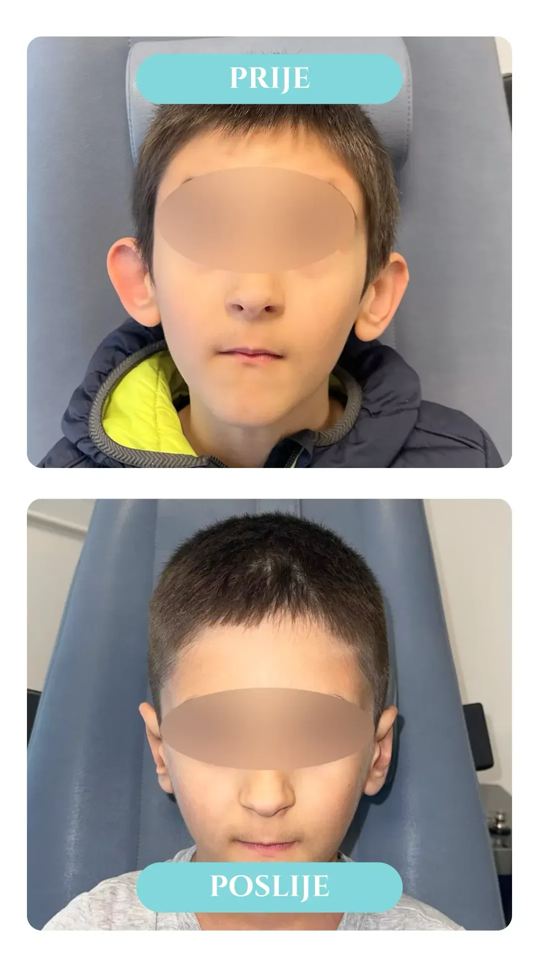 Otoplastika — slučaj 2, prije i poslije