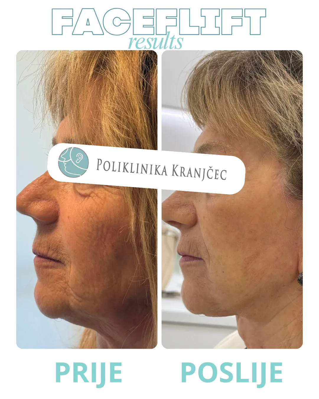Facelift — slučaj 3, prije i poslije