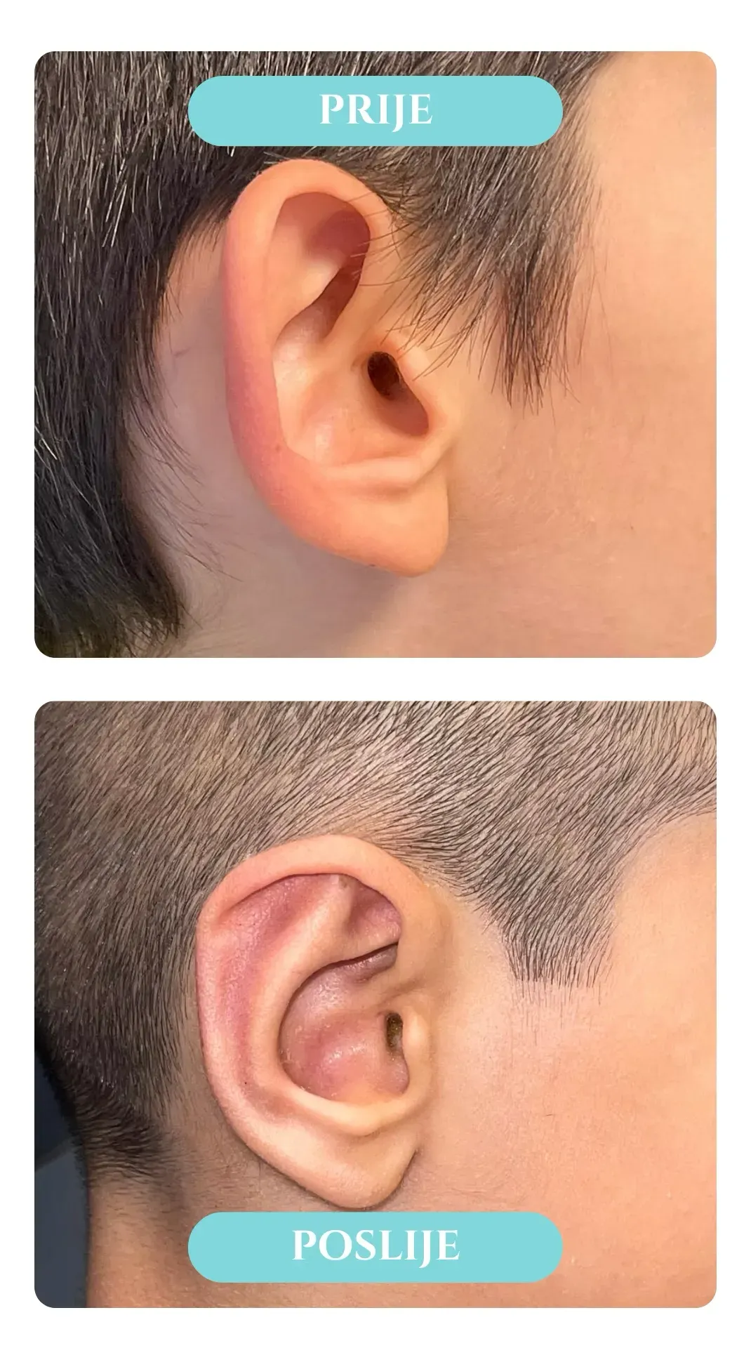 Otoplastika — slučaj 4, prije i poslije