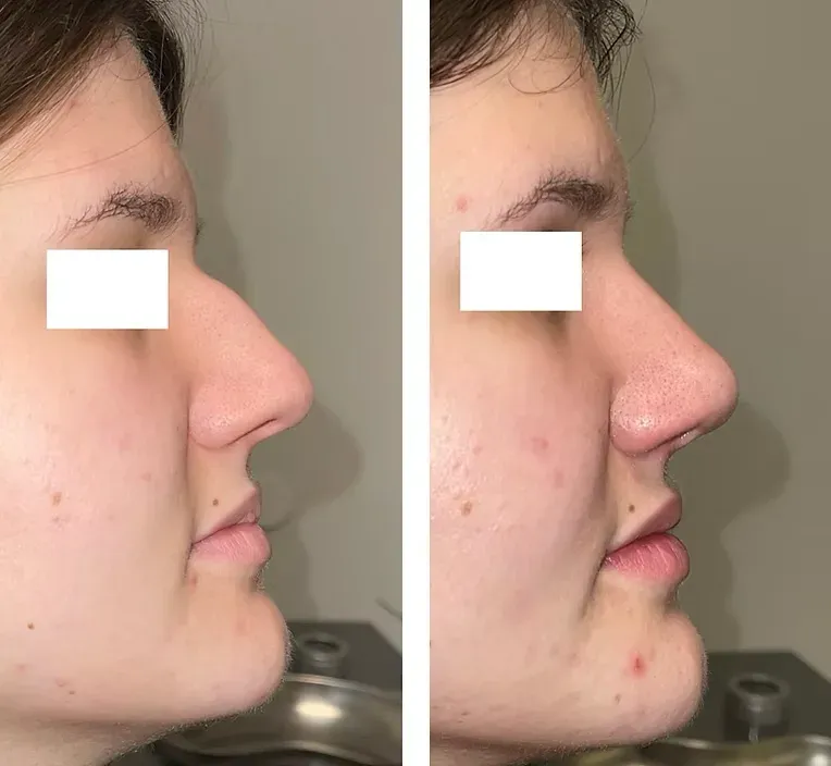 Rinoplastika — slučaj 4, prije i poslije