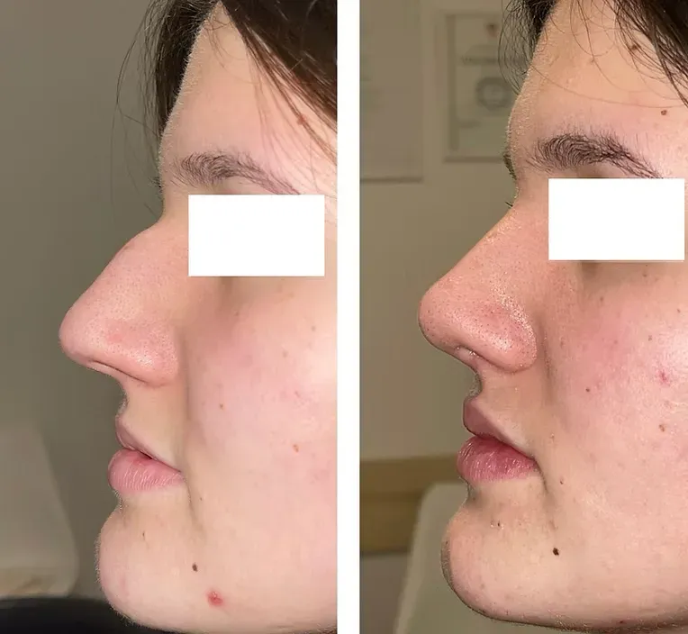 Rinoplastika — slučaj 5, prije i poslije