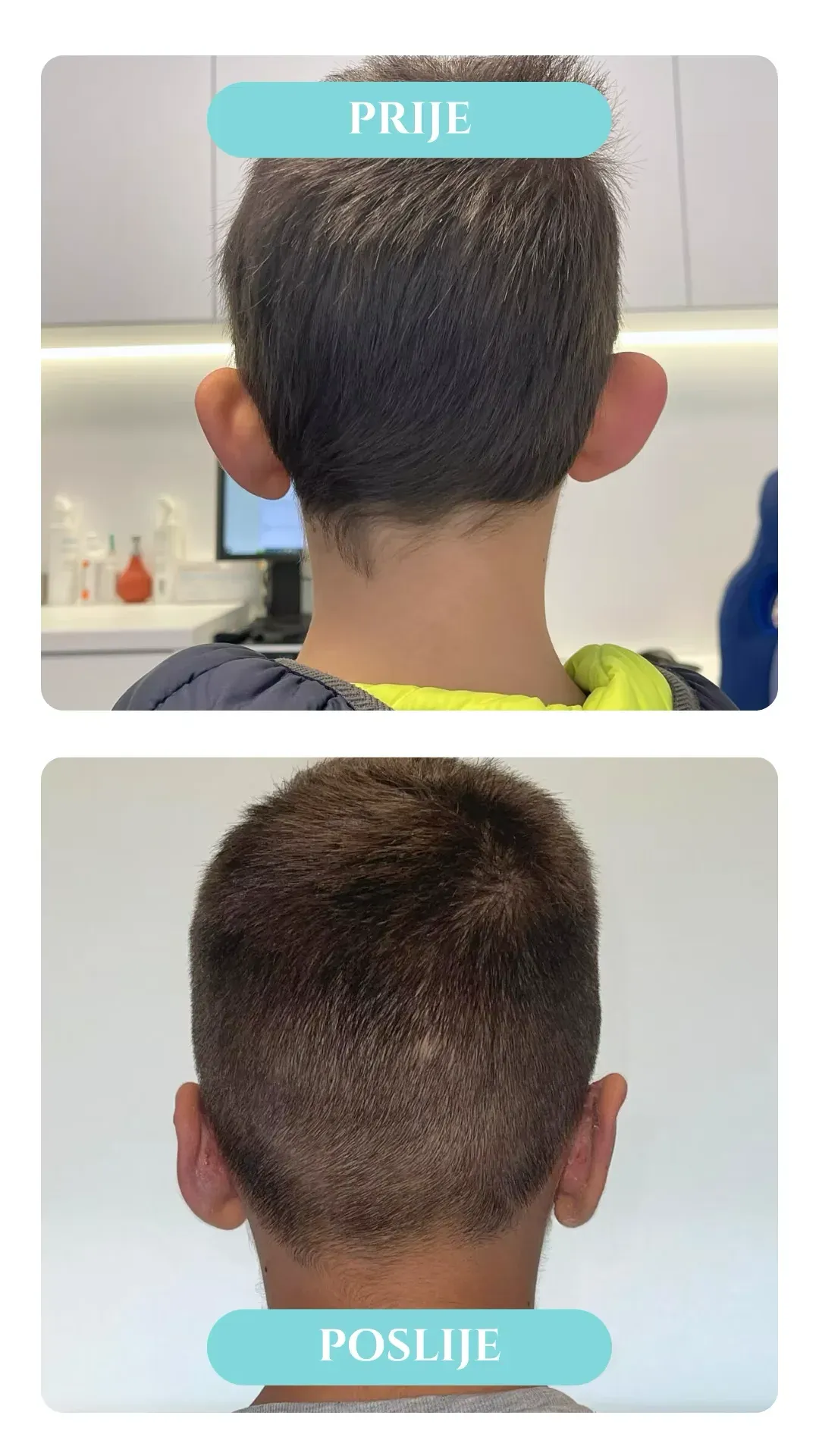 Otoplastika — slučaj 5, prije i poslije