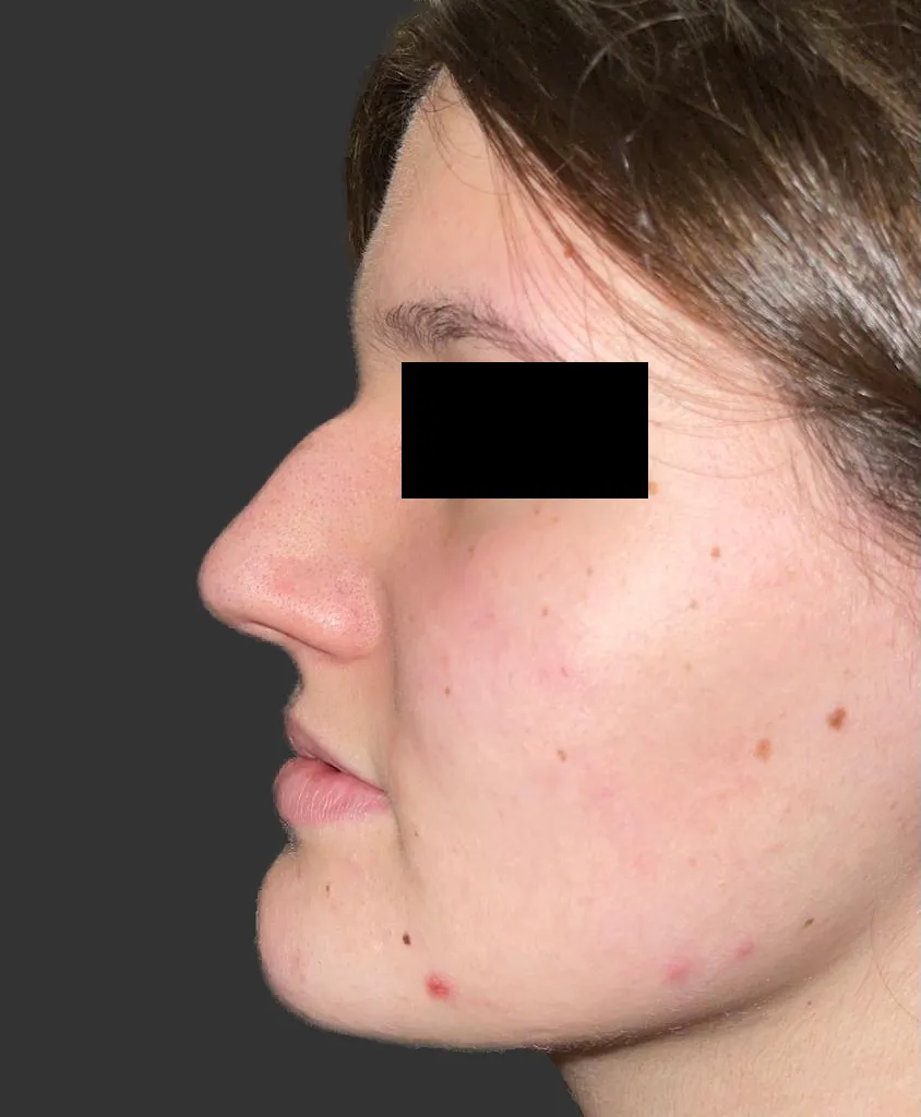 Prije — rinoplastika — operacija nosa