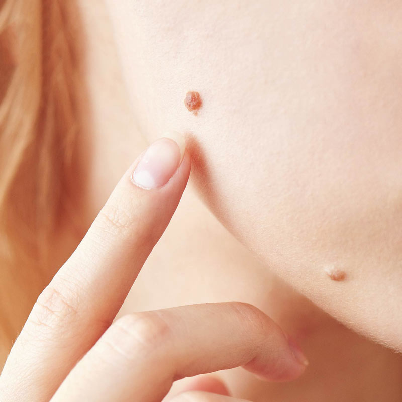 Pigmented lesions