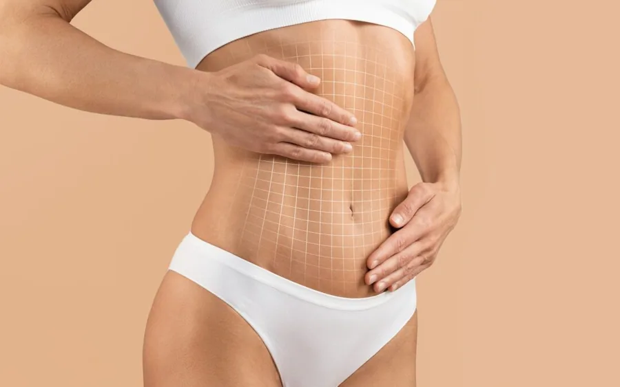 Abdominoplasty and tightening the abdominal wall