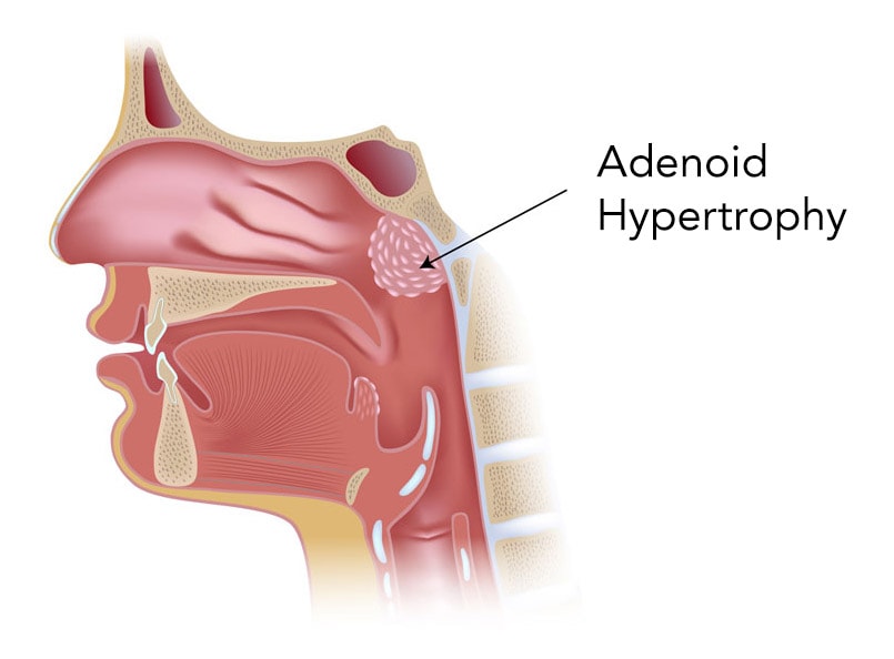 Adenoidectomy