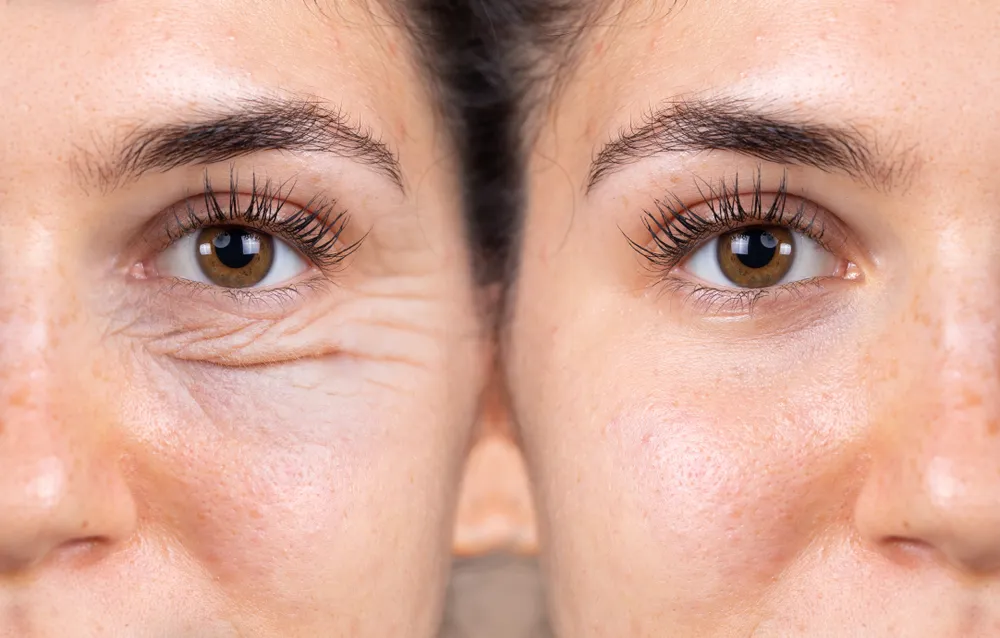Blepharoplasty and the area around the eyes