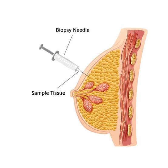 Fine-needle aspiration of the breast