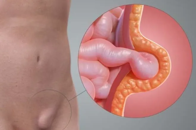 Inguinal hernia in a child — a bulge of tissue through the abdominal wall