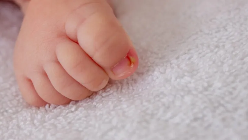 Ingrown toenail on a child's big toe — inflammation of the nail edge
