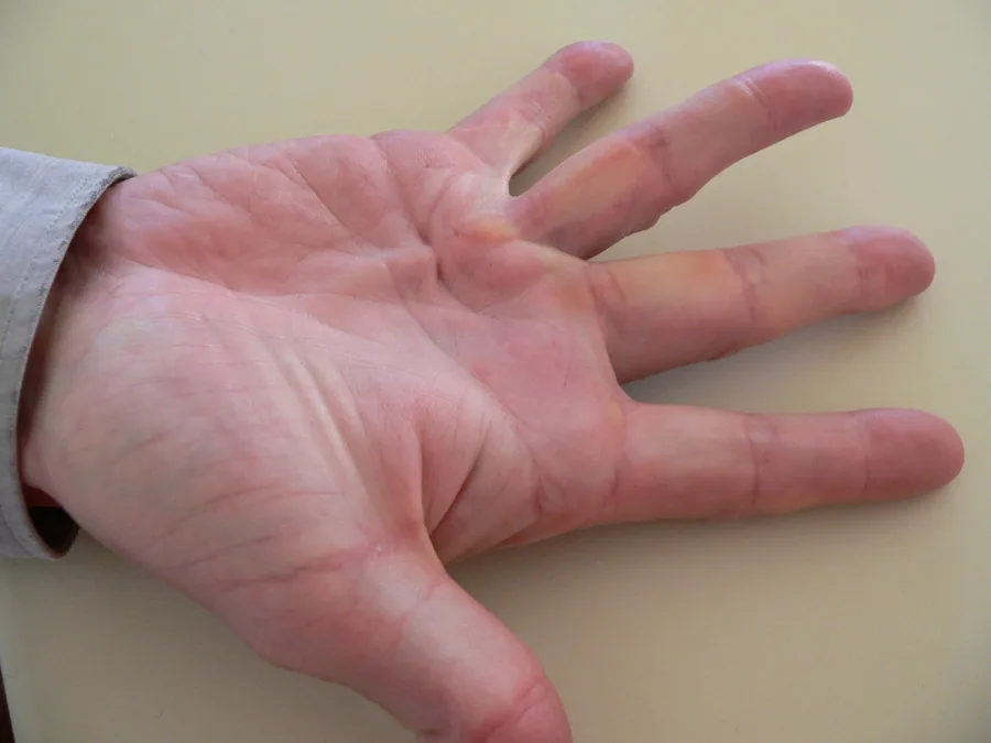 Dupuytren's contracture of the hand