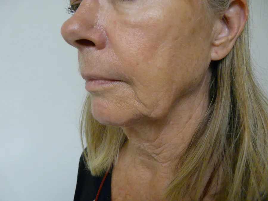 Sagging of the jawline (jowls) — an indication for a facelift