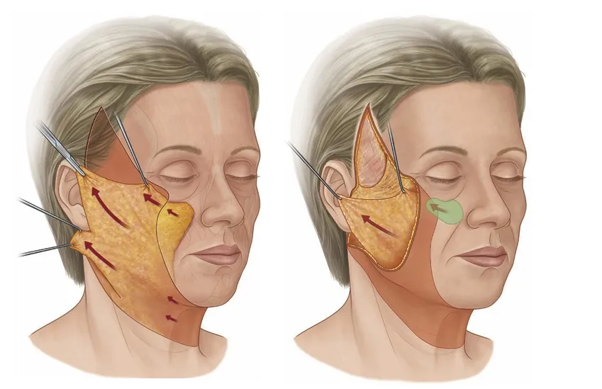 SMAS and deep plane facelift technique — an illustration of lifting the deeper facial layers