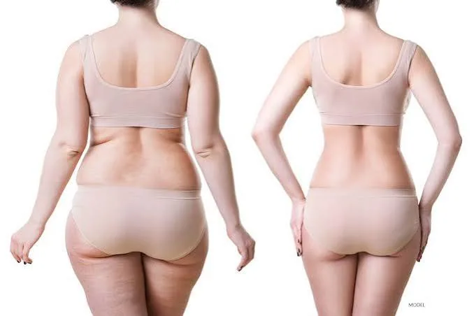 Body liposuction and contouring