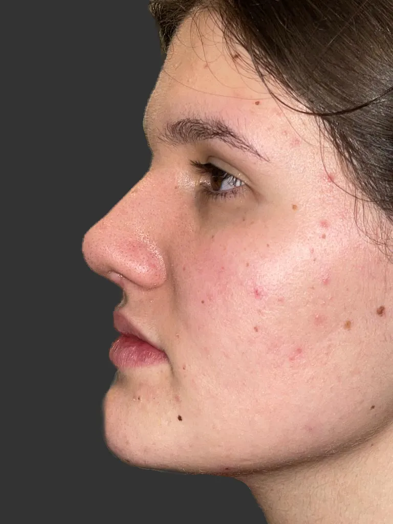 After rhinoplasty — a patient's profile, case 2