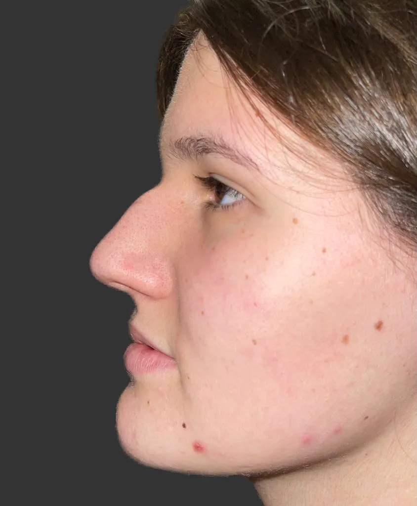 Before rhinoplasty — a patient's profile, case 2