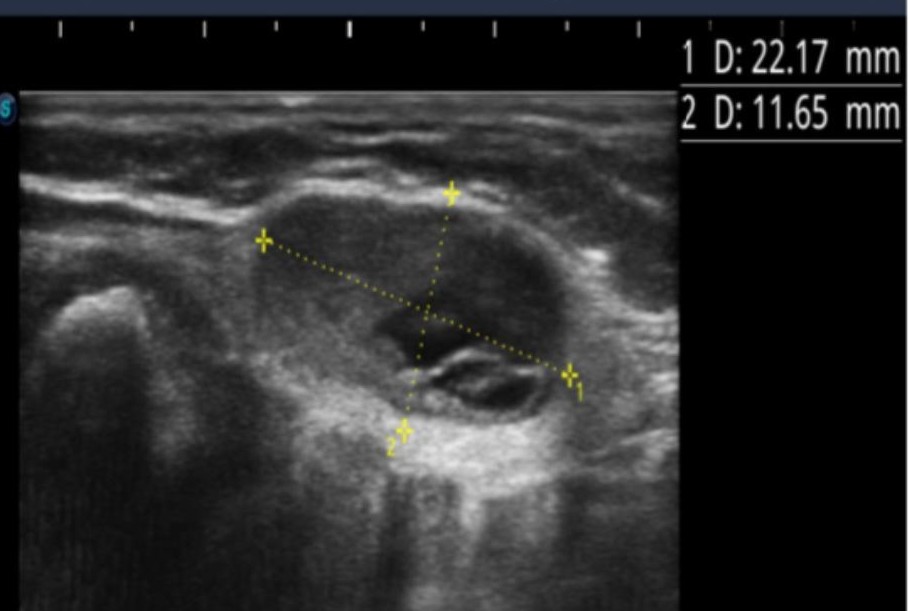 Thyroid ultrasound — a nodule before laser ablation, 22.2×11.7 mm