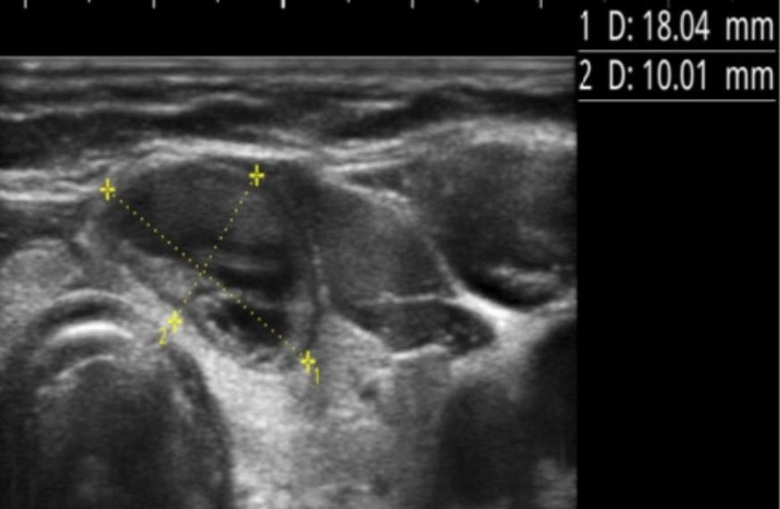 Thyroid ultrasound — the nodule after laser ablation, 18×10 mm