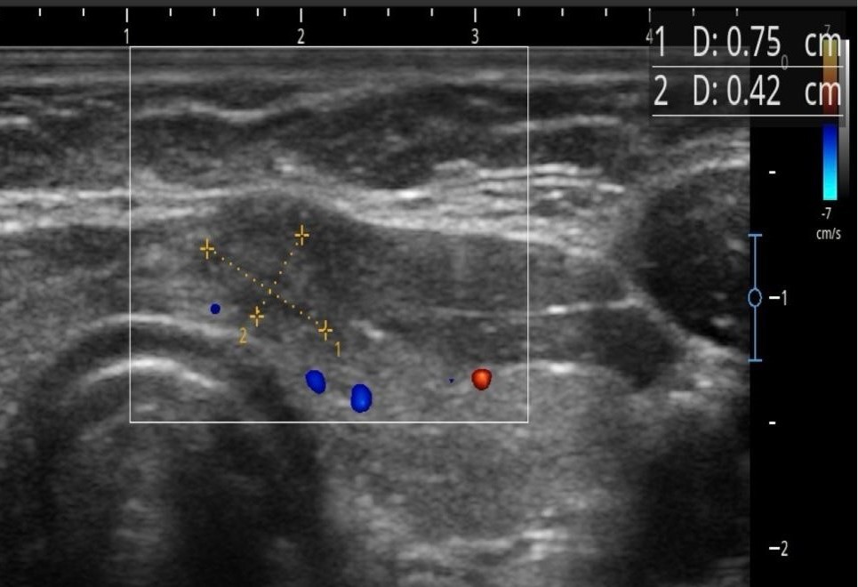 Thyroid ultrasound — a follow-up several months after ablation, 7.5×4.2 mm