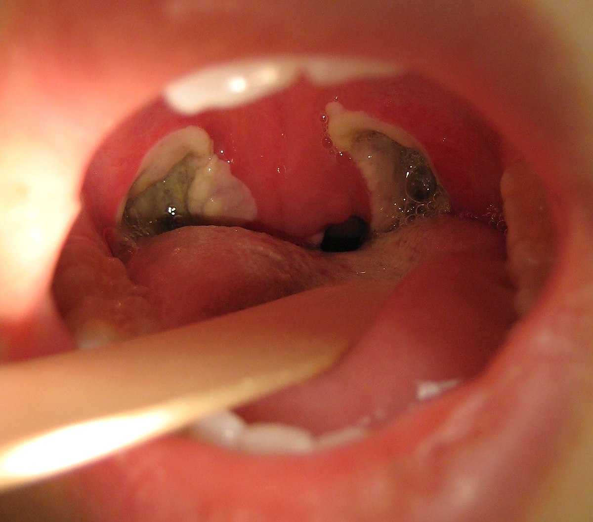 Tonsillectomy