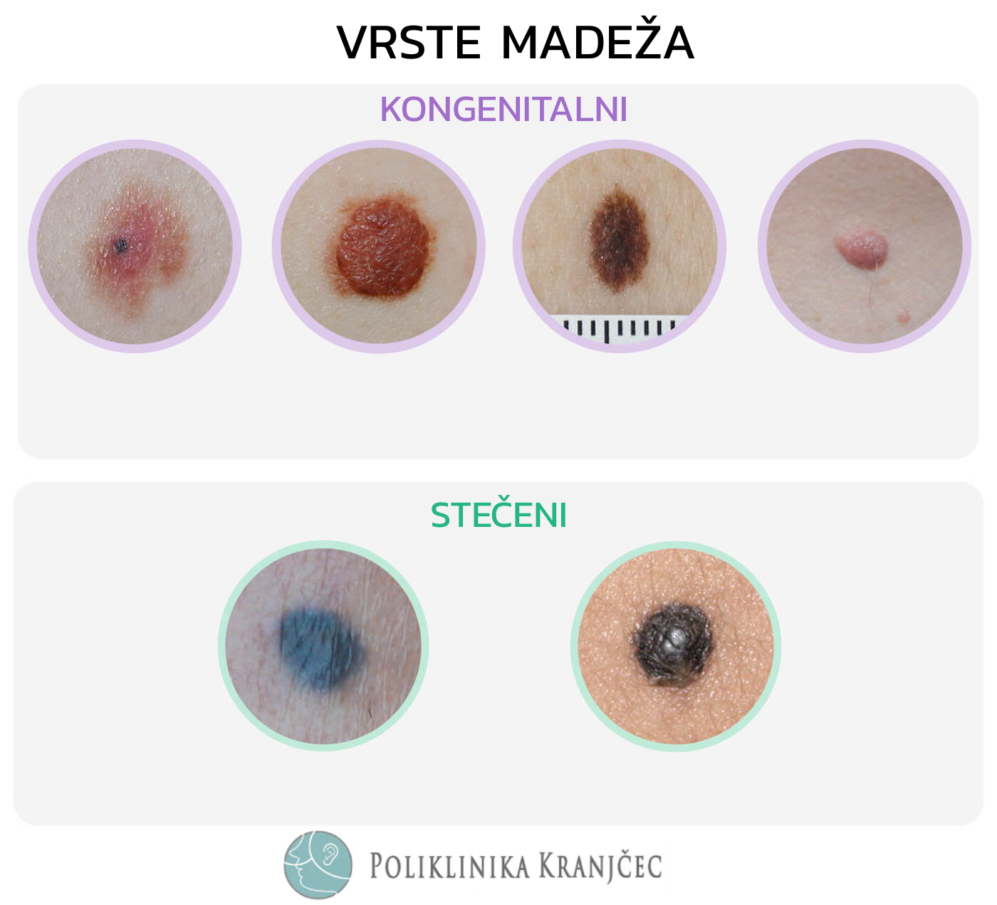 Vrste madeža — melanocitni nevi